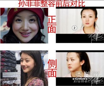 包子脸到锥子脸的蜕换 被疑整容的10大女星(图)